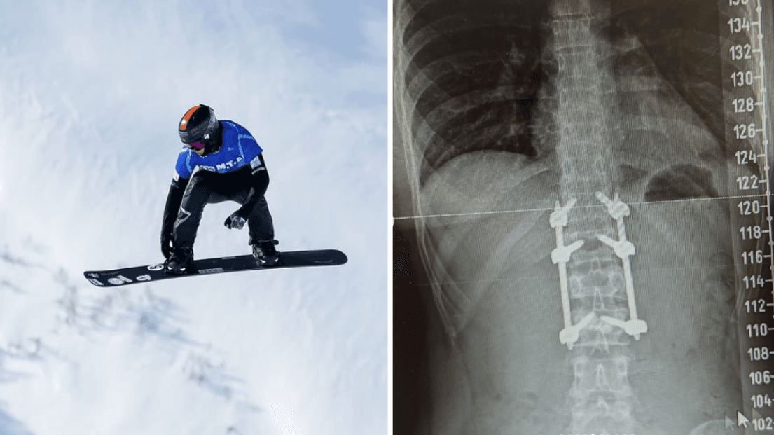 "Risk of spinal collapse": Olympic legend forced to retire